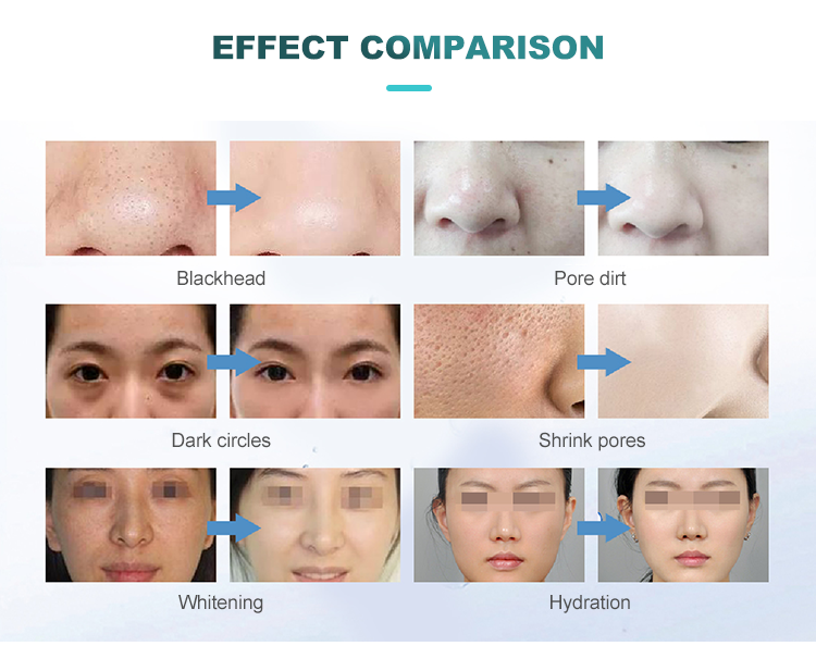 New 7 In 1 Smart Ice Blue Hydra Oxygen Facial, Skin Cleaning, Skin Analyzer, and Dermabrasion