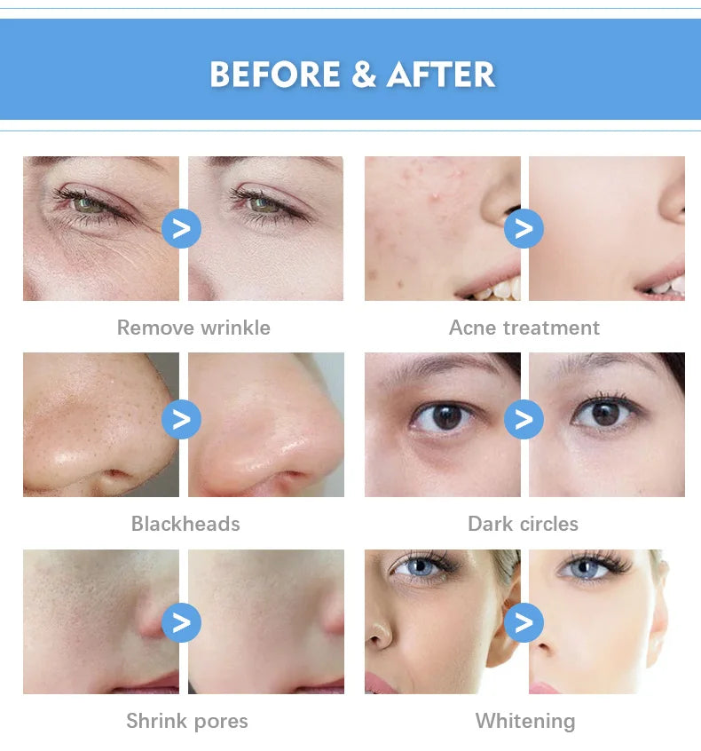 Best Smart Ice Blue, 7 In 1 Professional, Facial Treatment Machine